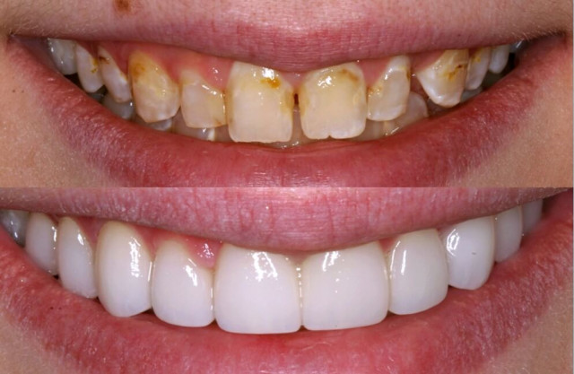 Celina Dentistry in Texas| Cosmetic Dentistry | Dental Implants | Prosper TX Orthodontist
