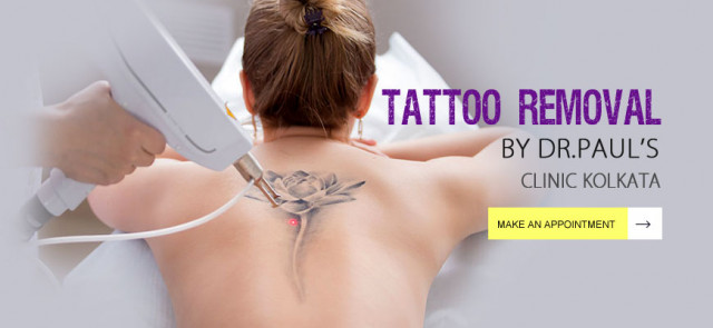 Permanent Tattoo Removal in Kolkata