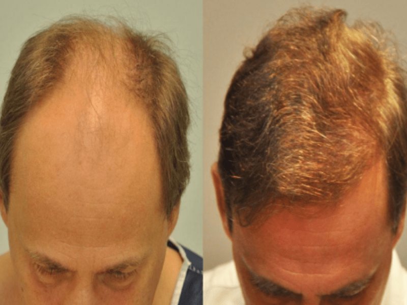 Mittal Hair Clinic