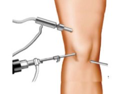 Total, Partial Knee Replacement Surgery Specialist Surgeon in Mumbai | Dr. Amyn Rajani